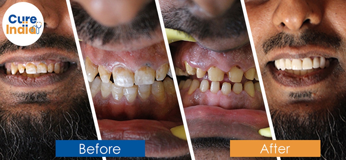 Dental Crown Before and After Case 6